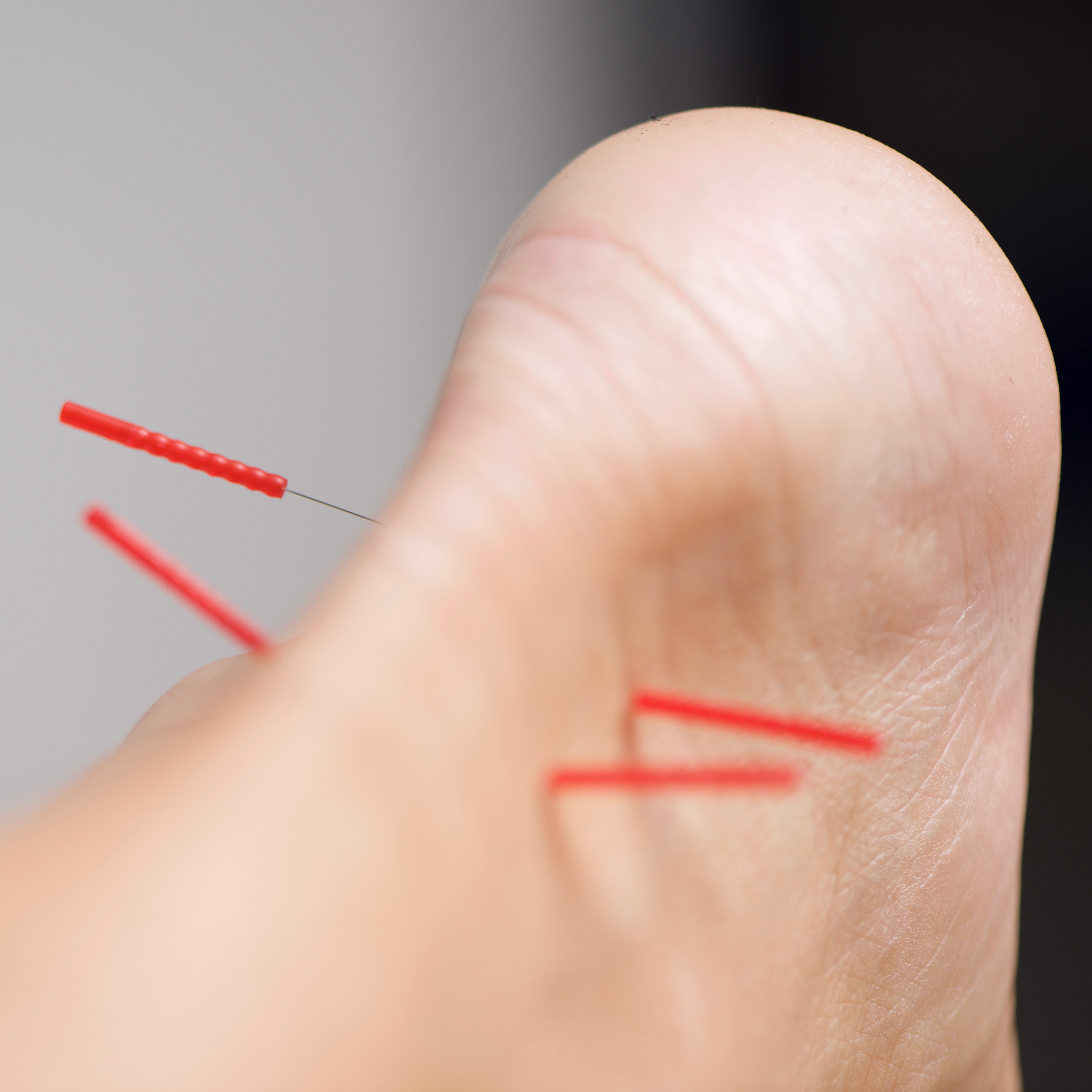 In-chalet acupuncture service