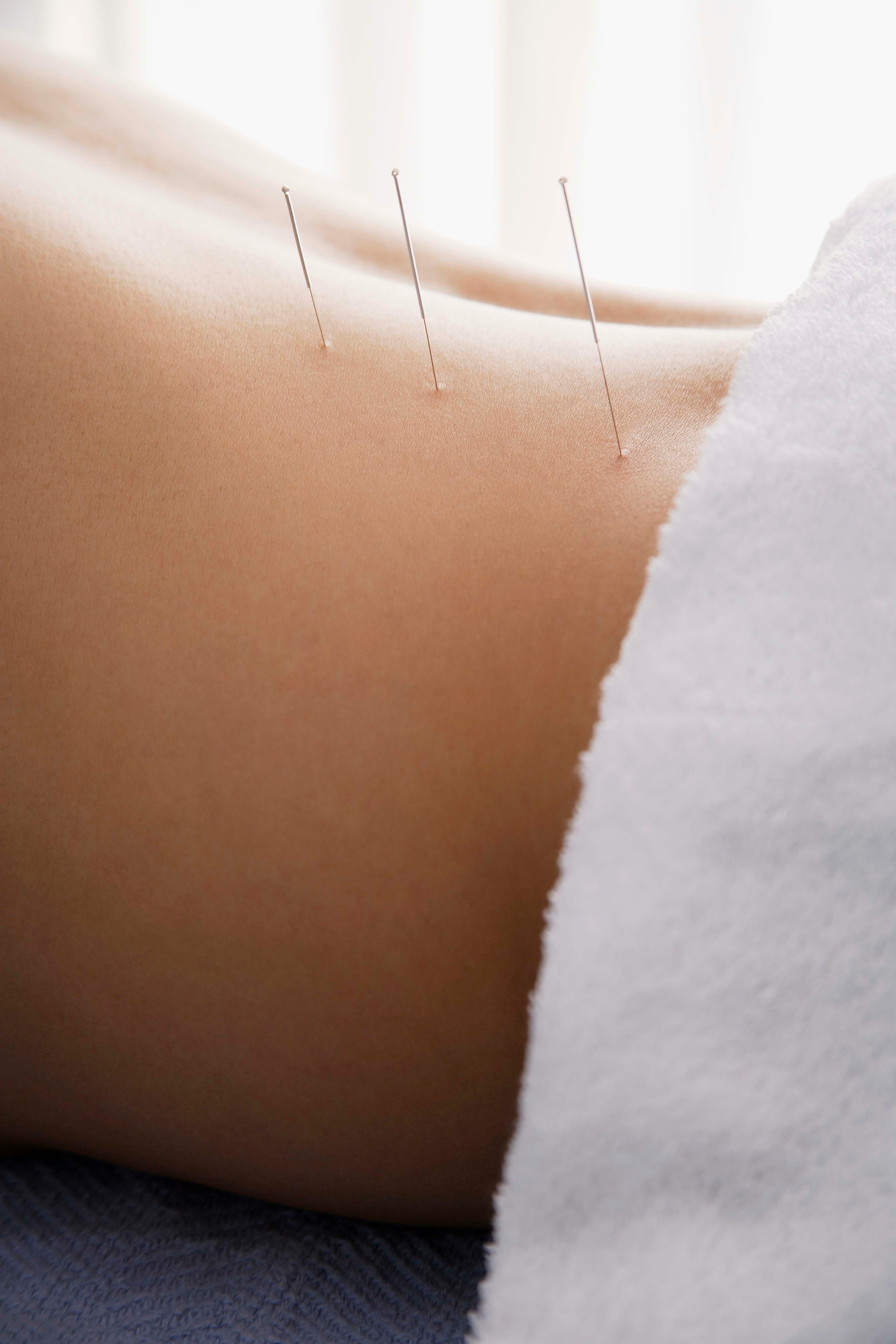 Professional acupuncture treatment in Verbier